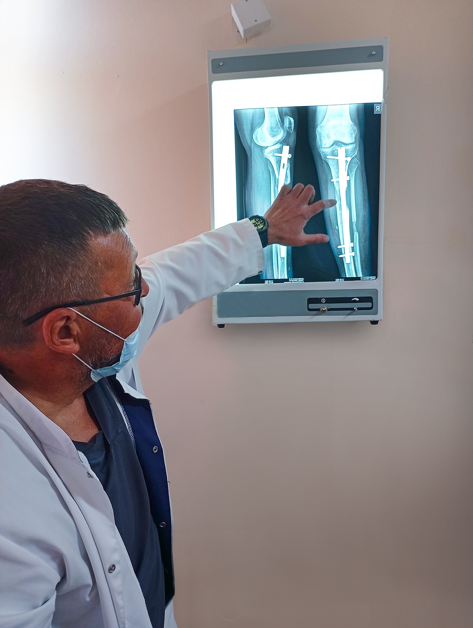 В МКБ Святителя Луки провели операцию по удлинению голени